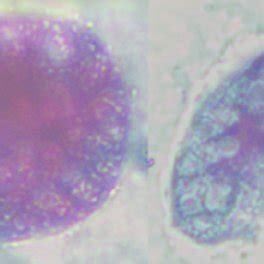 (PDF) A case report of an uncommon parasitic infection of human balantidiasis