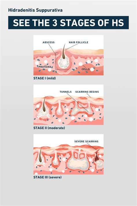 HS Symptoms & Pictures | No BS About HS