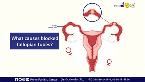 What causes blocked fallopian tubes? | Prime Fertility Center