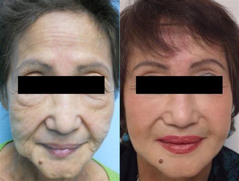 Liquid Facelift in Temecula, CA | Dr. Kelly O'Neil