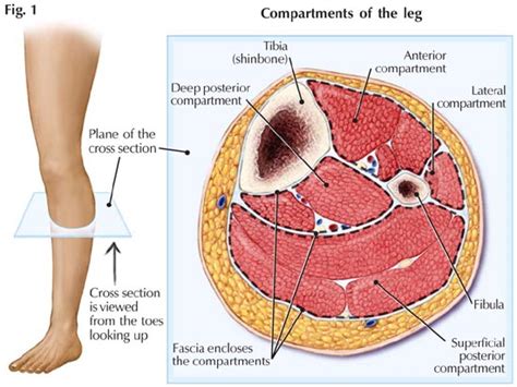 What is Compartment Syndrome? | LEGS ON FIRE