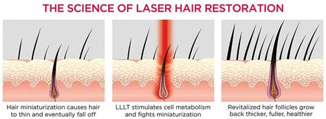 LASER HAIR GROWTH SYSTEM 2019 BEST | Hair Transplant in Turkey