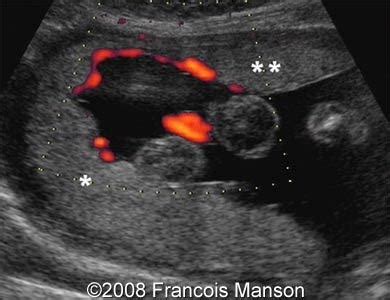 Succenturiate Lobe Placenta Ultrasound