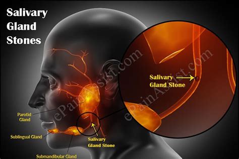 The Healthy Tips: Causes of Salivary Gland Stones & its Treatment, Home Remedies