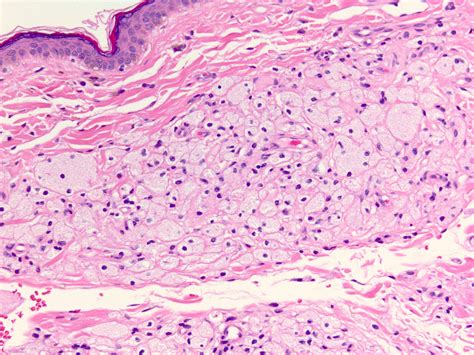 Pathology Outlines - Xanthelasma