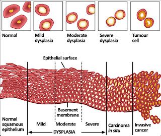 Cervical Dysplasia in Women ~ New York Doctors Walk-In Urgent Care