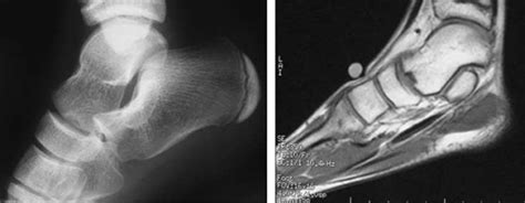 Defining Talar Head and Neck Pathology: The Malvern Classification ...