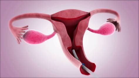 Insertion of an intrauterine device into the uterus. Motion Background - Storyblocks