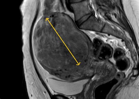 Texture Analysis of MRI Scans for Post-embolization Evaluation ...