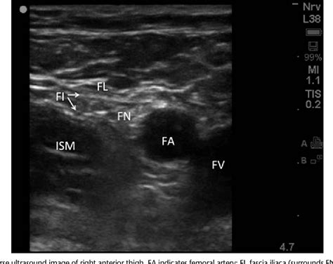 Figure 2 from Ultrasound-Guided Femoral Nerve Blocks. | Semantic Scholar