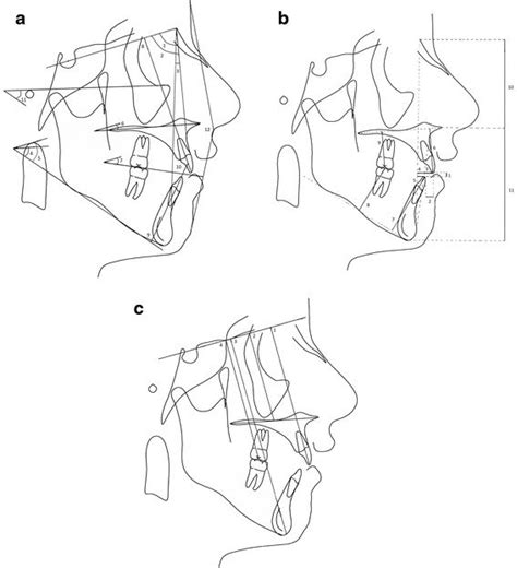 The cephalometric measurements. (a) Angular measurements: 1, SNA angle;... | Download Scientific ...