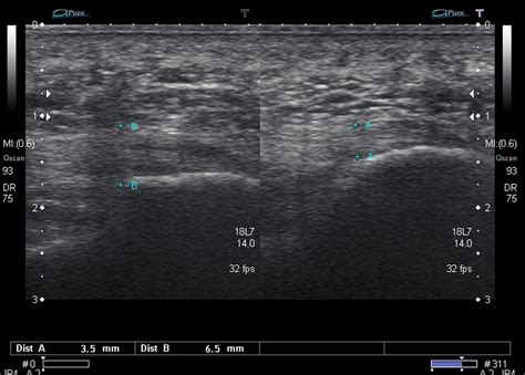 Ultrasound Images of Plantar Fasciitis - Ankle, Foot and Orthotic Centre