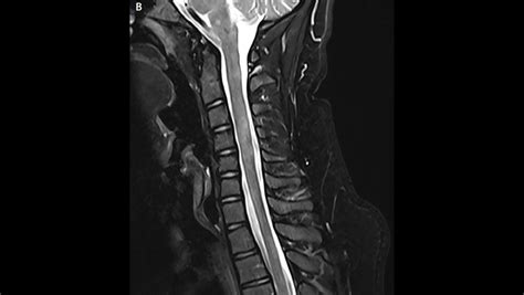 Spinal Cord Lesions - The Neurology Hub