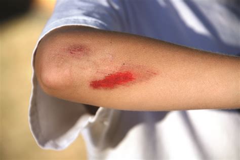 Bleeding and Injuries - Irish Haemophilia Society