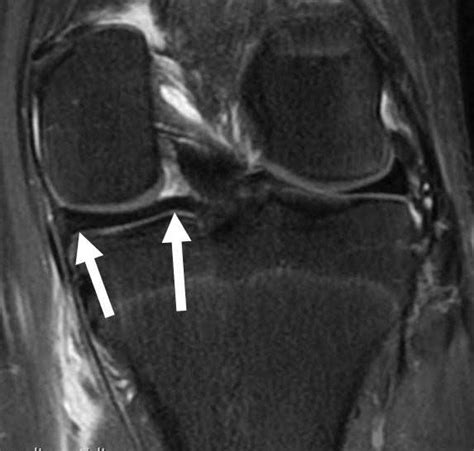 Posterior Horn Medial Meniscus Tear | Knee Specialist | Minnesota