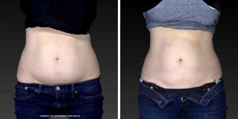 All About CoolSculpting | Fat-Freezing Treatment, Before & After Photos