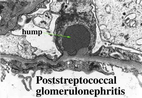 Acute Post Streptococcal Glomerulonephritis | Medical Junction