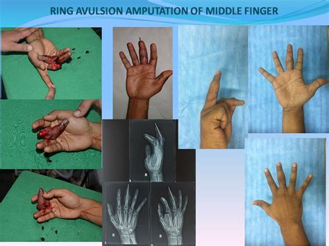 Avulsion Finger