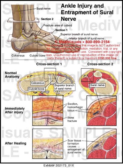 Ankle Injury and Entrapment of Sural Nerve Medical Illustration