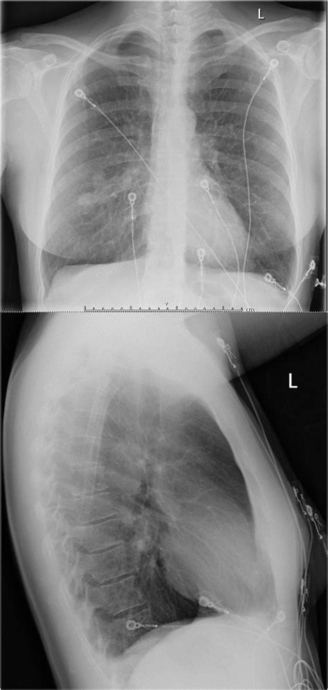 a. Chest X-Ray AP and Lateral view showing right mid-zone mass lesion. | Download Scientific Diagram