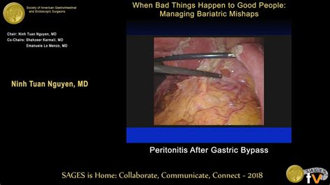 Laparoscopic Graham patch repair of a perforated marginal ulcer 6 yrs after RYGB - YouTube