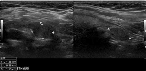 TIRADS : What Radiologists need to know | RadioGyan.com - RadioGyan