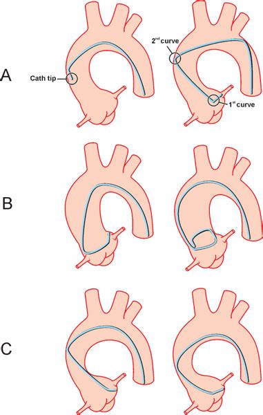 Coronary, Renal, and Mesenteric Angiography | Thoracic Key