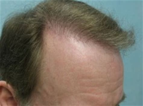 Temple Hair Transplant - DermHair Clinic Los Angeles 1-310-318-1500