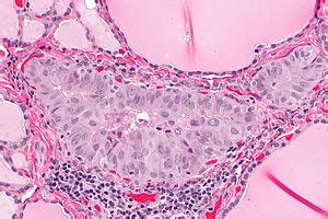 Papillary thyroid carcinoma - Libre Pathology