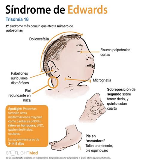 El Síndrome de Edwards - CURSO DE PEDIATRÍA - Paradigmia