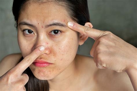 Zinc for Acne: This is How The Active Ingredient Helps with Pimples