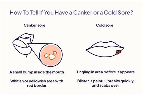 Treating Herpes Mouth Ulcers - Infoupdate.org