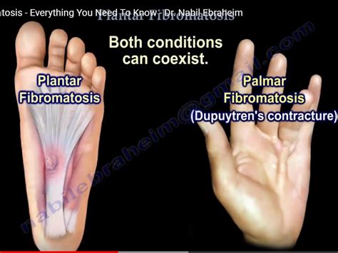 Plantar Fibromatosis — OrthopaedicPrinciples.com