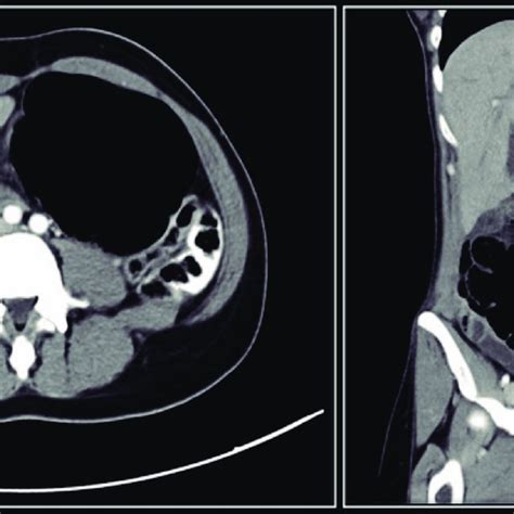 Frontal section showing the formation of splenocolic ligament and ...