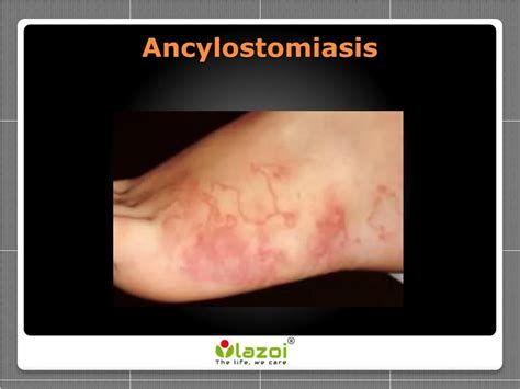 PPT - Ancylostomiasis - Symptoms, Treatments and Preventions PowerPoint ...