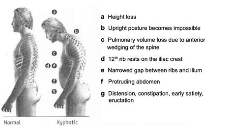 Compression Fracture Neck Symptoms at Carolyn Murphy blog