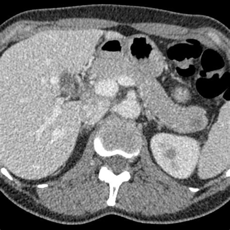 CT scan with a new isolated hypodense lesion in the tail of the... | Download Scientific Diagram