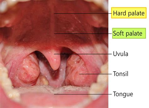 Hard palate anatomy, hard palate function, hard palate cancer & bump