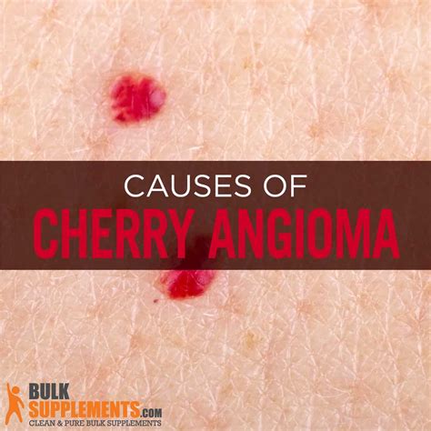 Cherry Angioma: Characteristics, Causes & Treatment