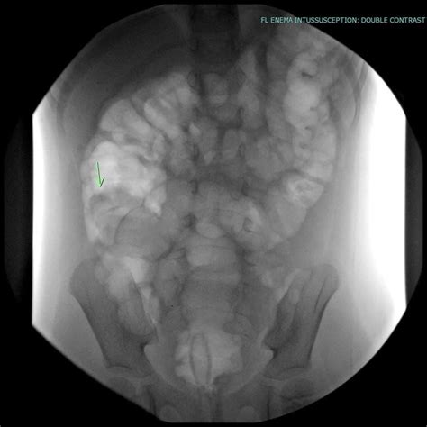 Intussusception | UAMS Department of Radiology