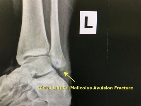 What Is Avulsion Fracture, How To Prevent And Rehabilitate It? — Best Bainbridge Island Physical ...