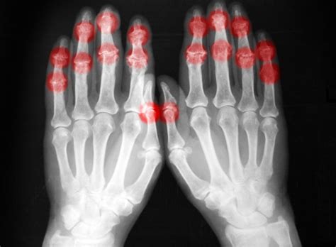 Osteoarthritis and Rheumatoid Arthritis Symptoms: How to Relieve the Pain - University Health News