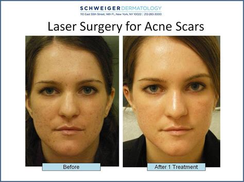 Fractional CO2 Laser for Acne Scars | Clear Clinic