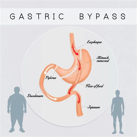 Gastric bypass surgery — Stock Photo © adrenalina #172688554