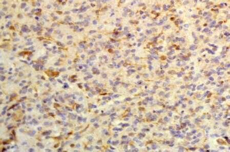 -Cathepsin B weak expression (1+) in glial tumor cells. | Download ...