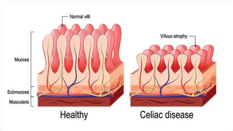 Celiac Disease: Causes & Complications - SuccessYeti