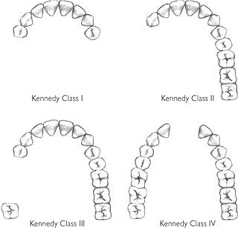 Partial Denture Design - Bauer Smiles