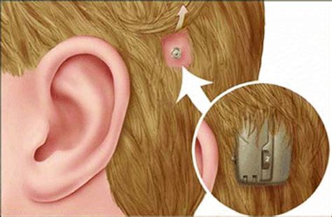 Types of Hearing Aid Devices