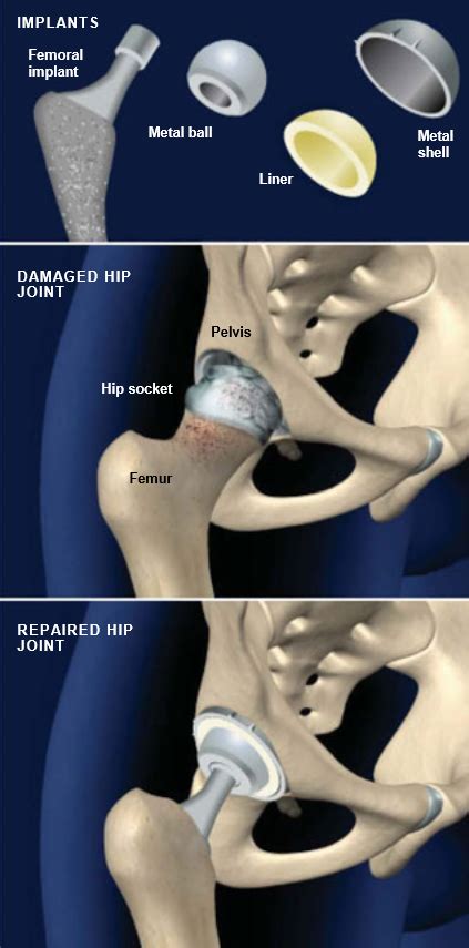 Total Hip Replacement, Anterior Approach | Central Coast Orthopedic Medical Group