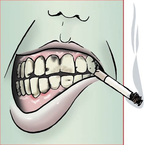 Smoking prompts tooth decay, oral cancer | Article | The United States Army